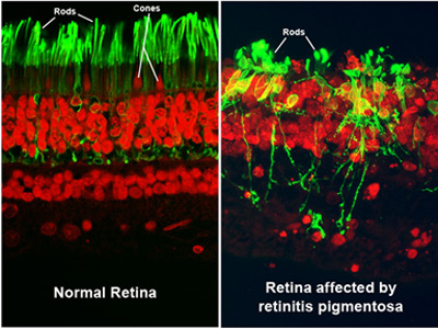 retinitisPigmentosa1
